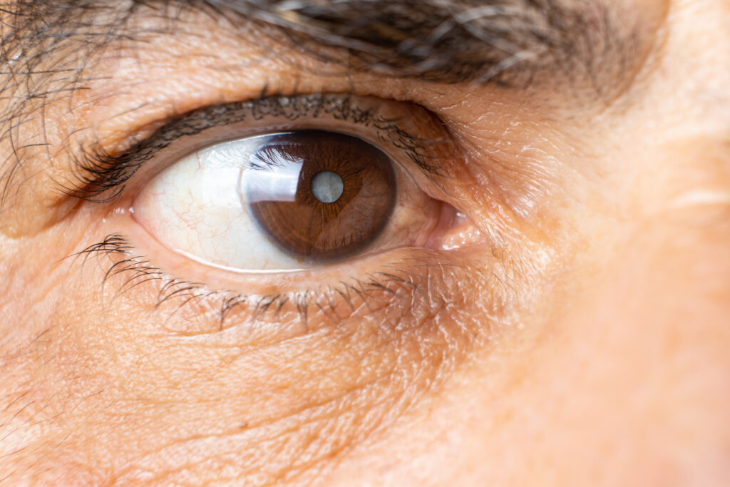 Close up image of a man's eye with cataracts